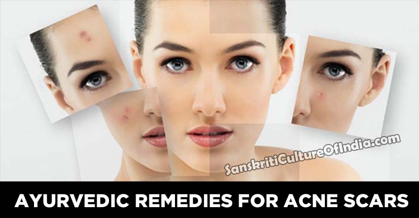 Ayurvedic remedies for acne scars | Sanskriti - Hinduism and Indian ...