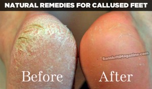Natural remedies for callused feet